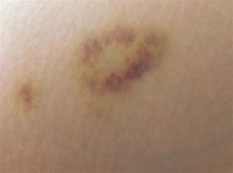 Can Skin Cancer Look Like A Bruise - CancerWalls