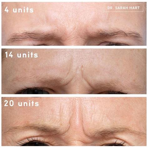 How many units of botox for forehead first time - Cosmetic Surgery Tips