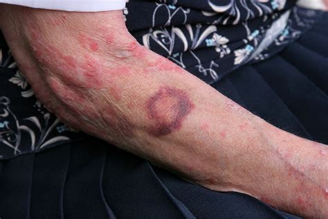 Home Health Care: When Should You Worry About Bruises? - Prime Home Health