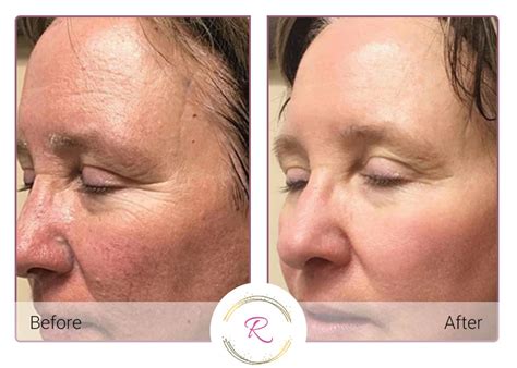 ClearLift Skin Resurfacing - Revitalized Aesthetics and Beauty Bar