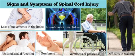 Spinal Cord Injury - Causes, Symptoms, Diagnosis, Treatment & Prevention