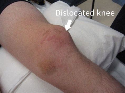 Dislocated Knee: Symptoms, Causes, Treatment By Knee Braces