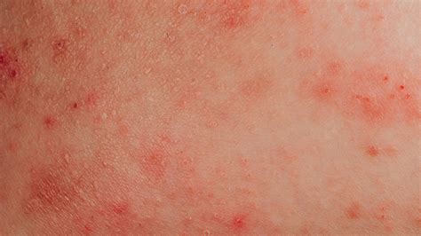 Encuesta sobre dermatitis atópica: por qué es mucho más que una enfermedad de la piel - Reporte ...