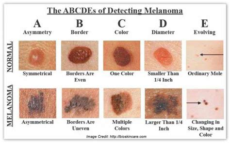 Melanoma Skin Cancer Stages