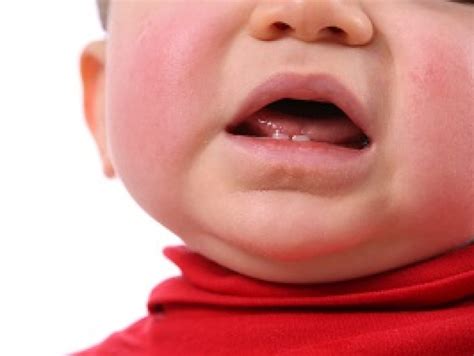 Teething rash: how to help your baby | Baby & toddler articles & support | NCT