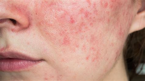 Rosacea - GoodRx