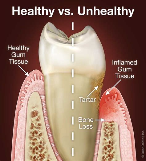 Periodontal Gum Disease | Snowmass Village Dental | Snowmass Village ...