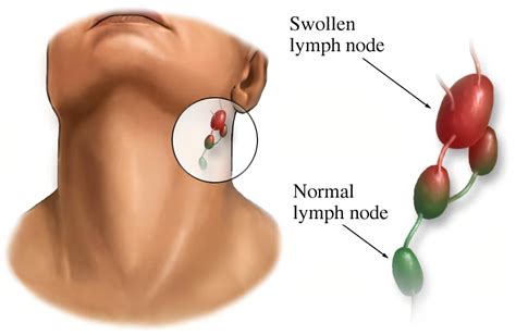 Swollen Lymph Nodes: How Can Ayurveda Help? - Yatan Ayurveda