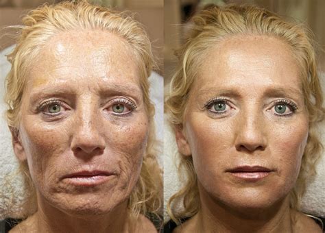 Filler Face Lift Before And After