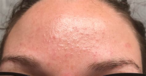 Help! My forehead is constantly textured like this for as long as I can remember with skin color ...