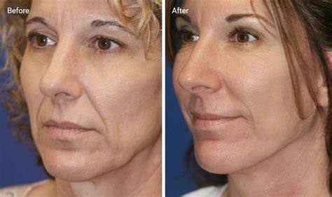 Radio Frequency Skin Tightening: Does It Work and Is It Safe