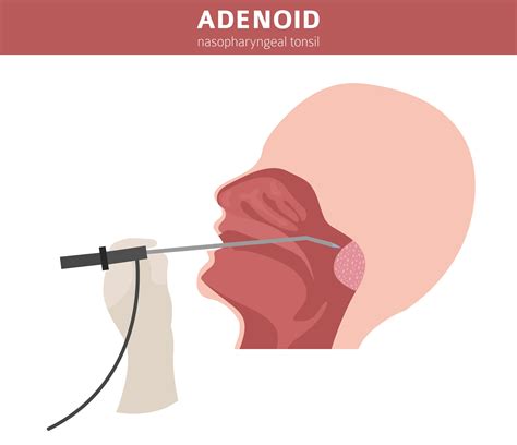 6 Things To Know About Adenoids and Surgery. | Credihealth