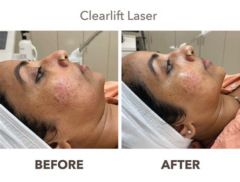 ClearLift Laser Skin Rejuvenation | for wrinkles and open pores