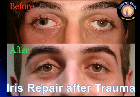 4 Cases of Surgical Iris Repair – Cataract Coach