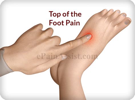 Top of the Foot Pain: Treatment, Exercises, Causes, Symptoms