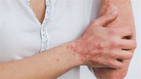 Psoriasis: Symptoms and treatment options | Health - Hindustan Times