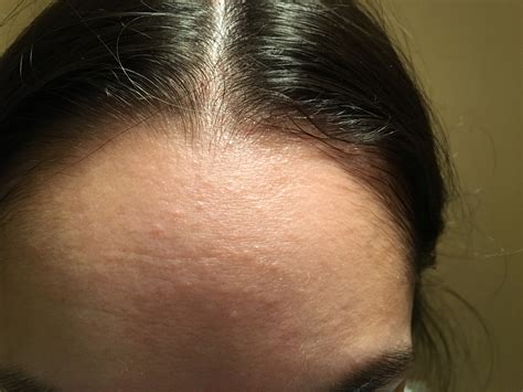 Small forehead bumps that won't go away - General acne discussion ...