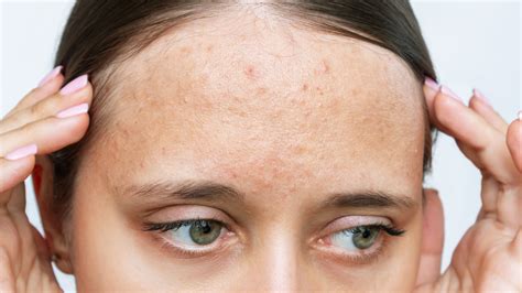 What Causes Forehead Acne & How Can You Treat It?