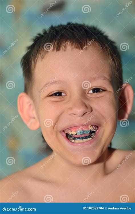 A child with braces smiles stock photo. Image of people - 102039704