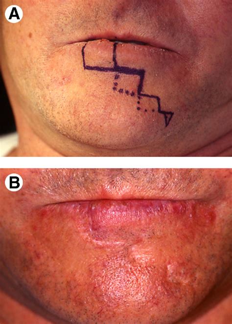 Pictures Of Lip Cancer After Surgery | Sitelip.org