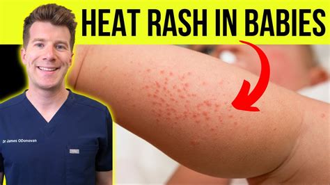 Heat Rash: Pictures, Symptoms, Causes, Types, And Treatment, 41% OFF