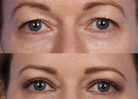 What is Hooded Eye Surgery? Your Definitive Guide to Blepharoplasty