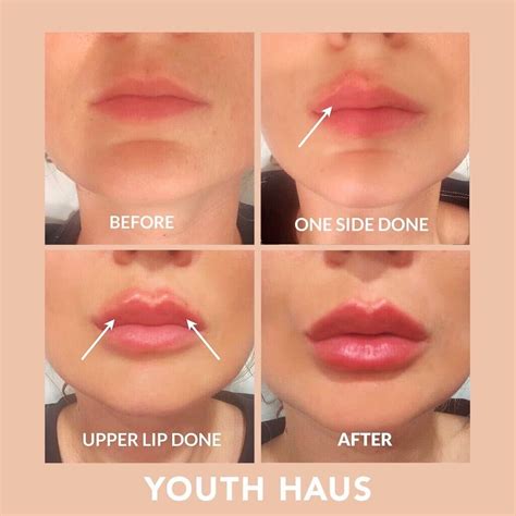 Juvederm Lips Before And After Half Syringe | Sitelip.org