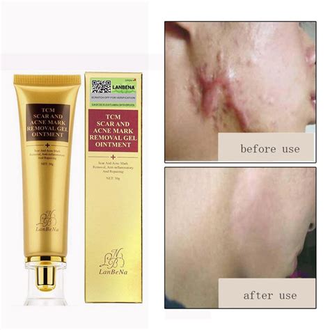 30 ml Profession Acne Scar Removal Cream Skin Repair Face Cream Acne Spots Acne Treatment ...