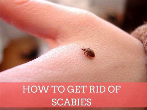 Scabies: Scabies Symptoms & Treatments