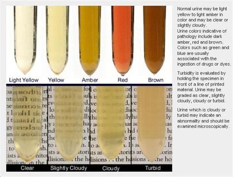 The 25+ best Cloudy urine causes ideas on Pinterest | Color of urine, Color of pee chart and ...