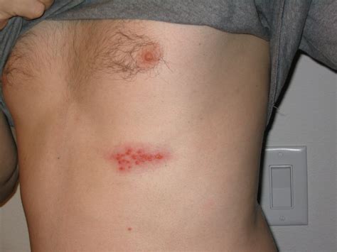 Herpes Zoster (Shingles) | Concise Medical Knowledge