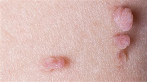 Skin Tags During Pregnancy | What to Expect