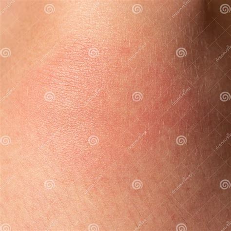 Allergy on the Human Body and Redness from a Wasp Sting. Stock Photo ...