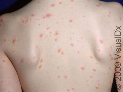 Adult Chicken Pox Stages