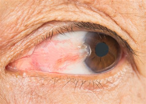 Pterygium (Surfer’s Eye): Causes, Symptoms & Treatment