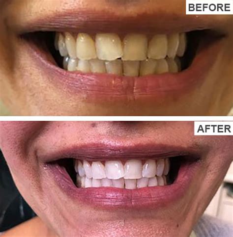 Teeth Whitening Before And After Pictures - Gorgeous Smiles