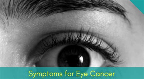 4 Categories & Symptoms of [Eye Cancer] You Must Know!