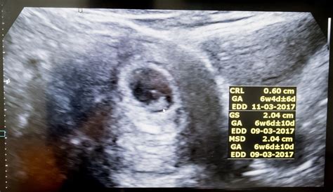 Is a 'fetal heartbeat' really a heartbeat at 6 weeks? | Live Science