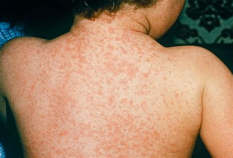 Meningitis Rash - Pictures, Symptoms, Causes, Treatment, Prevention | Diseases Pictures