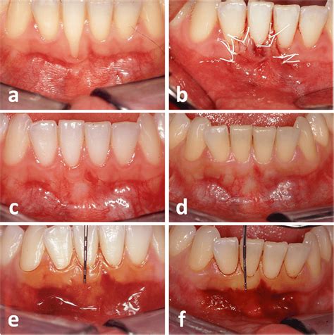 Gingival recession (GR) at the lower right first incisor (a). Recipient... | Download Scientific ...