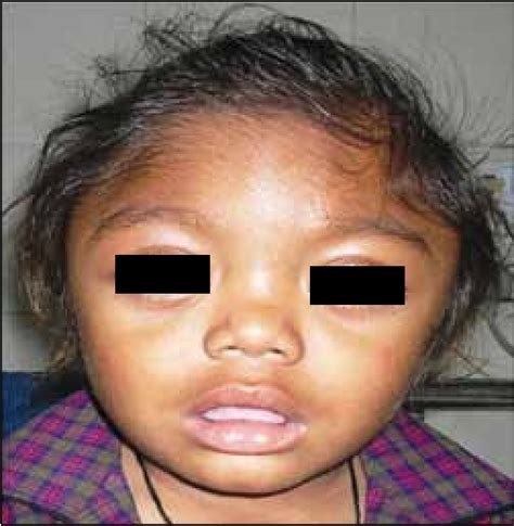 Figure 1 from Child with Mongolian spots and dysostosis multiplex | Semantic Scholar