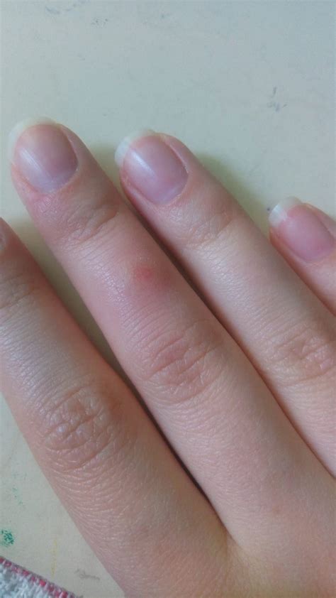 Help! What is this? I have this bump on my finger for two days. It's very itchy. It doesn't look ...