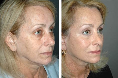 Orbitomalar Suspension During High Smas Facelift