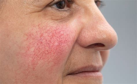 Blood Vessels: Diagnosis, & Treatment - Toronto Dermatology Centre