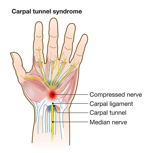 Physical Solutions | Carpal Tunnel Syndrome - Physical Solutions