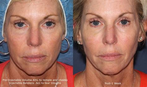 Liquid Facelift - Cosmetic Laser Dermatology Skin Specialists in San Diego