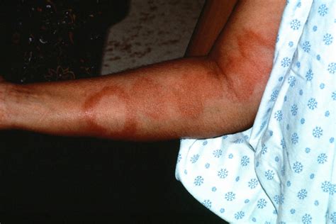 Leprosy disease causes, symptoms, diagnosis, treatment and cure