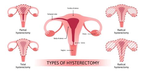 Should I Get a Hysterectomy for Fibroid Removal?| Fibroid Institute Texas