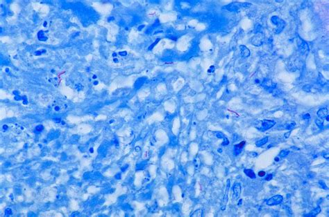 File:Mycobacterium tuberculosis Ziehl-Neelsen stain.jpg