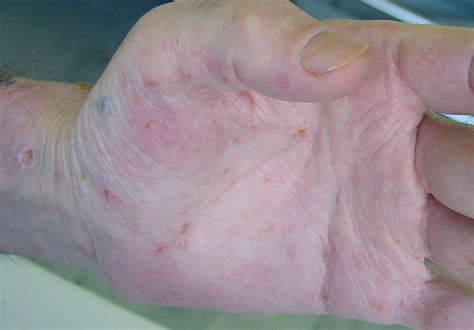 Scabies Rash Pictures